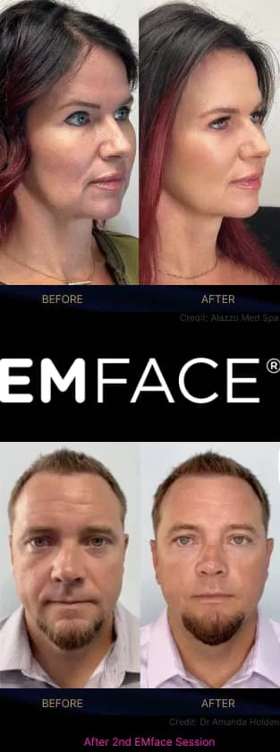 Two patients before and after EMface facial toning at our Amsterdam clinic