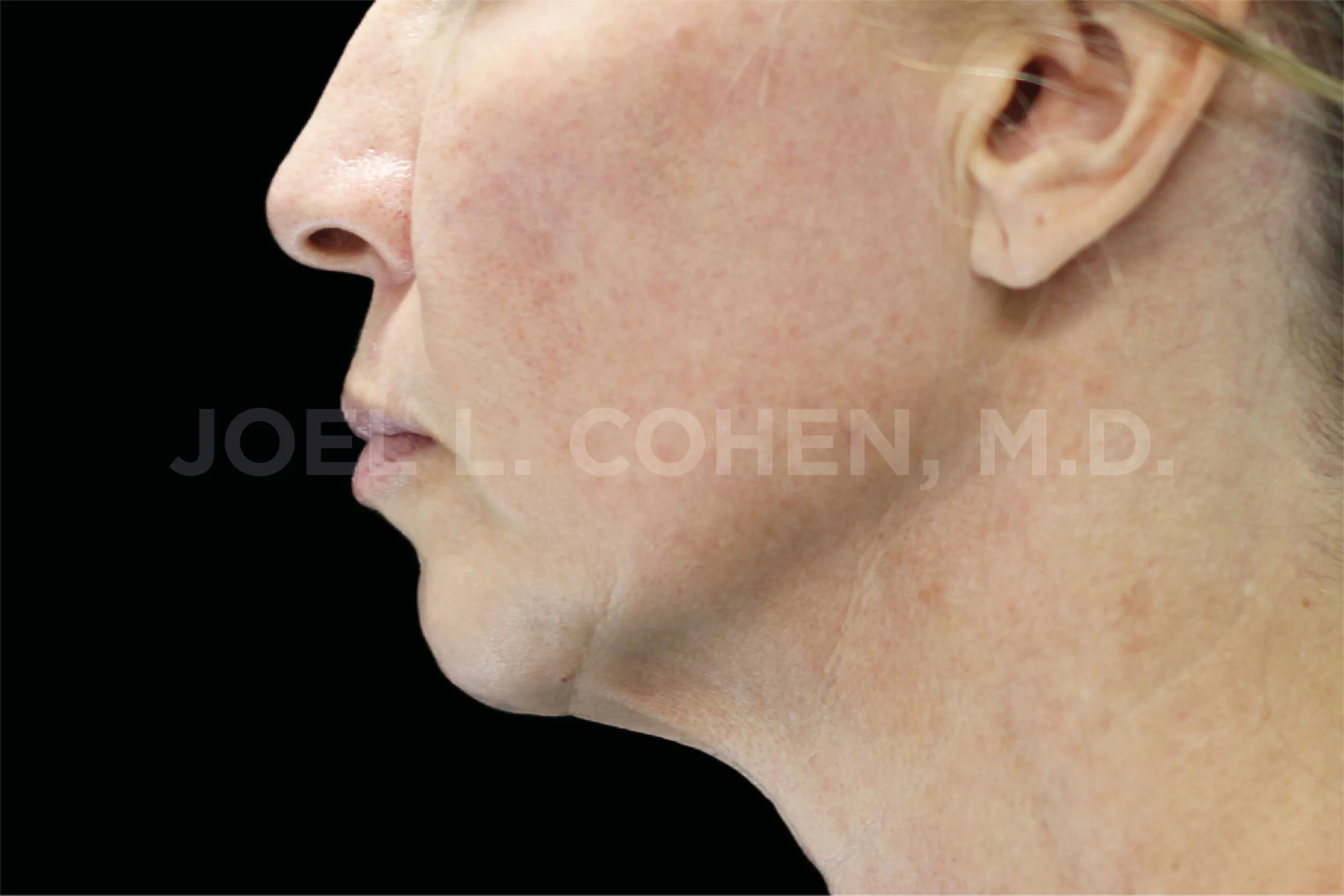 EMface facial toning Amsterdam - after photo of the jawline and neck in profile Jawline and neck in profile after EMface facial toning at our Amsterdam clinic