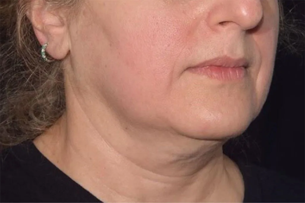 EMface facial toning Amsterdam - after photo of the jawline and neck Jawline and neck after EMface facial toning at our Amsterdam clinic