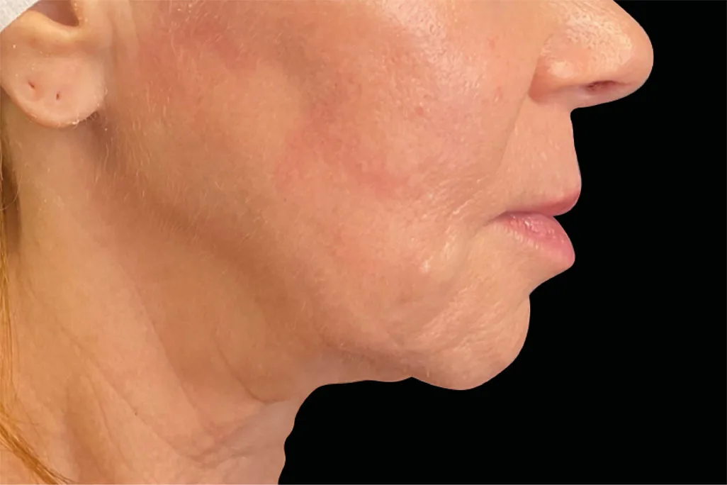 EMface facial toning Amsterdam - after photo of the neck in profile Neck in profile after EMface facial toning at our Amsterdam clinic