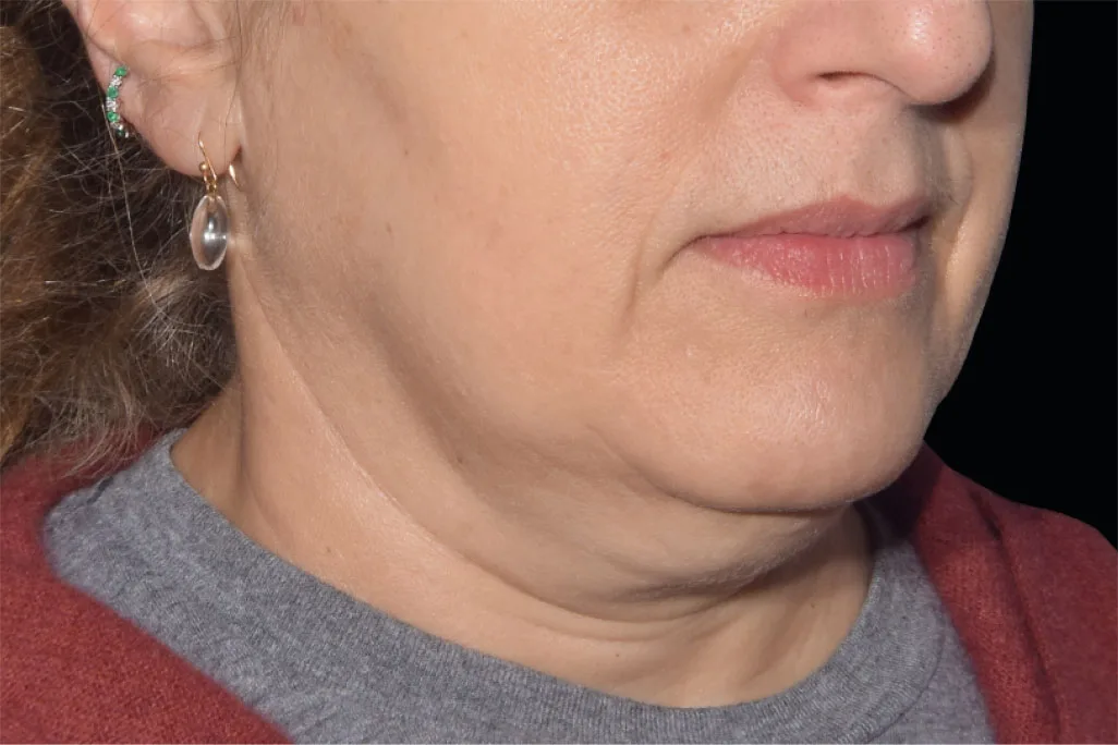 EMface facial toning Amsterdam - before photo of the jawline and neck Jawline and neck before EMface facial toning at our Amsterdam clinic