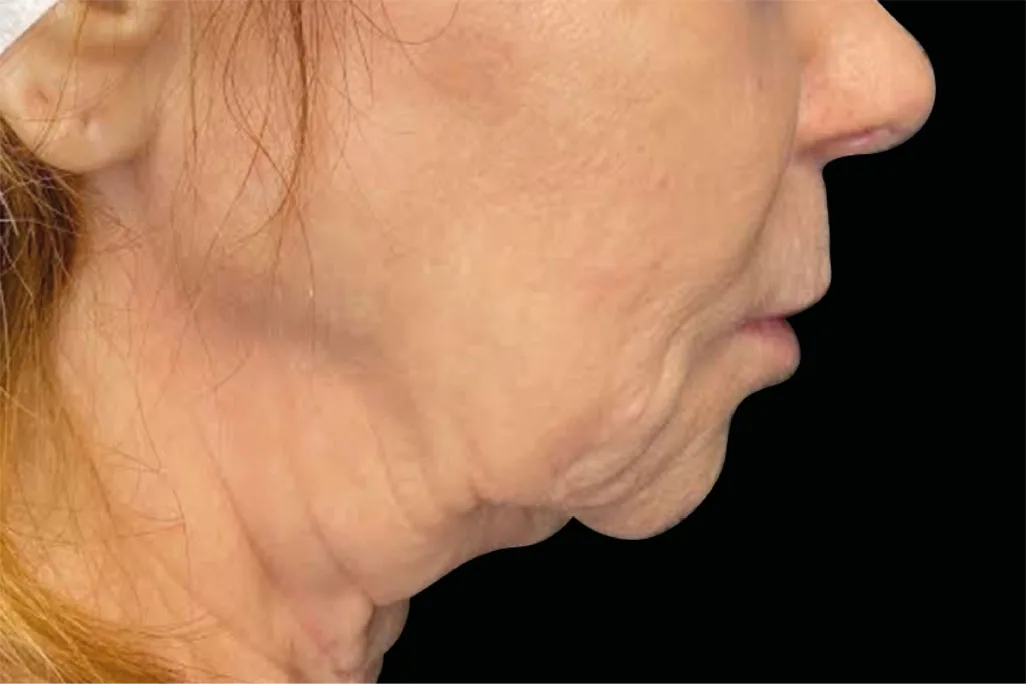 EMface facial toning Amsterdam - before photo of the neck in profile Neck in profile before EMface facial toning at our Amsterdam clinic