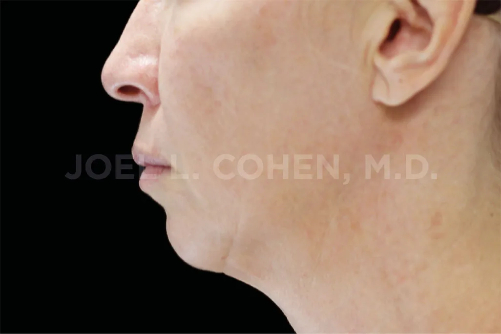 EMface facial toning Amsterdam - before photo of the jawline and neck in profile Jawline and neck in profile before EMface facial toning at our Amsterdam clinic